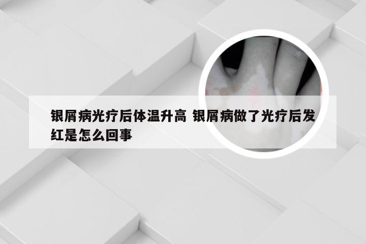 银屑病光疗后体温升高 银屑病做了光疗后发红是怎么回事