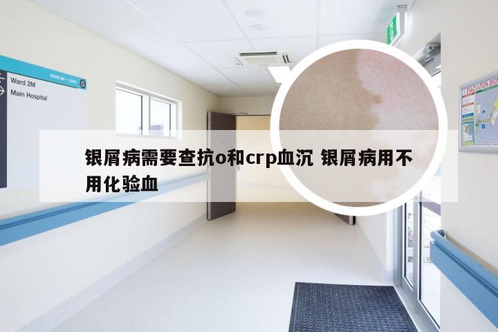 银屑病需要查抗o和crp血沉 银屑病用不用化验血