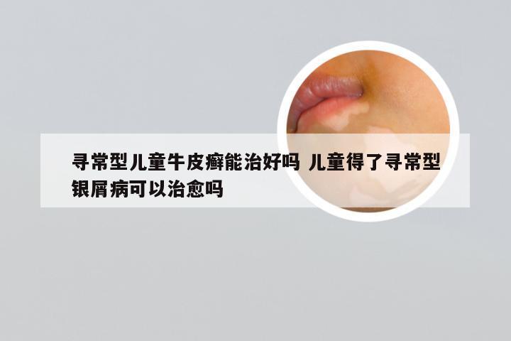 寻常型儿童牛皮癣能治好吗 儿童得了寻常型银屑病可以治愈吗