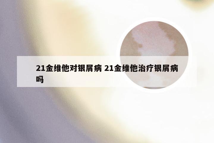 21金维他对银屑病 21金维他治疗银屑病吗