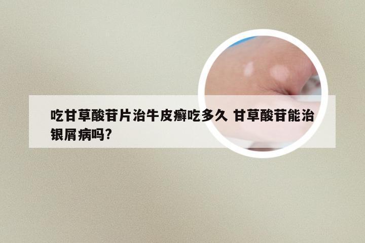 吃甘草酸苷片治牛皮癣吃多久 甘草酸苷能治银屑病吗?