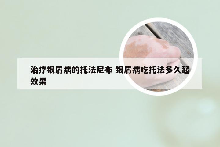 治疗银屑病的托法尼布 银屑病吃托法多久起效果