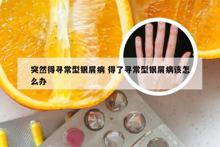 突然得寻常型银屑病 得了寻常型银屑病该怎么办