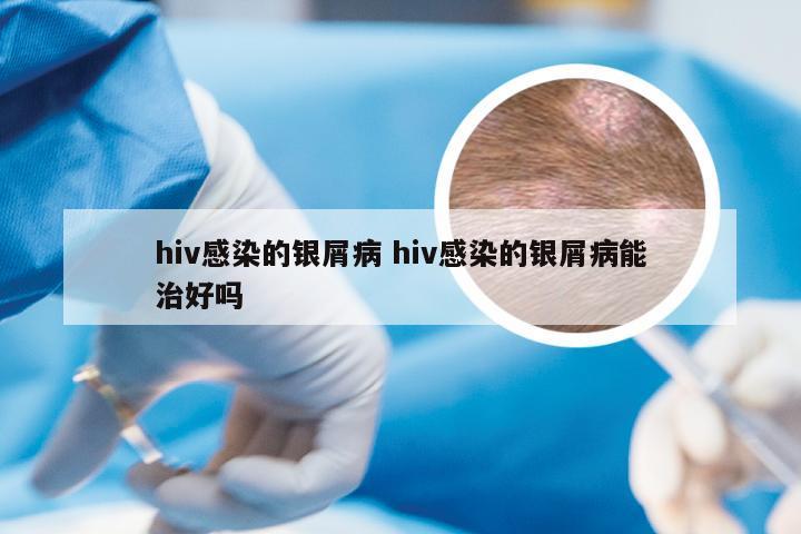 hiv感染的银屑病 hiv感染的银屑病能治好吗