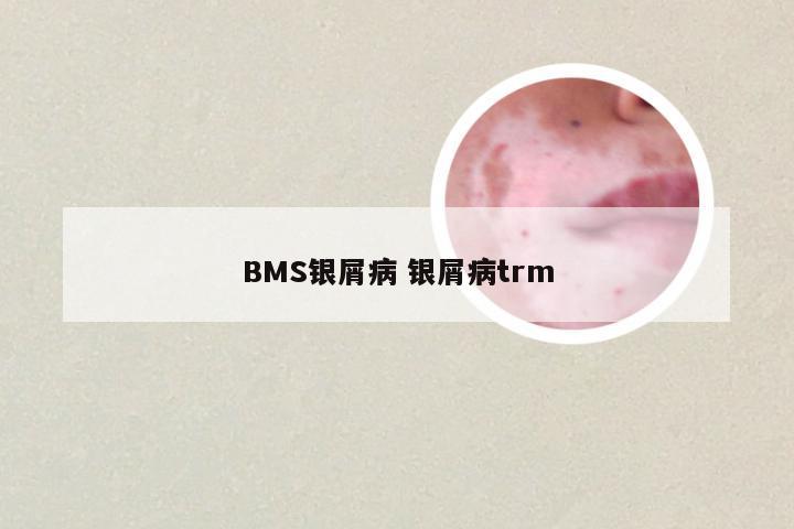 BMS银屑病 银屑病trm