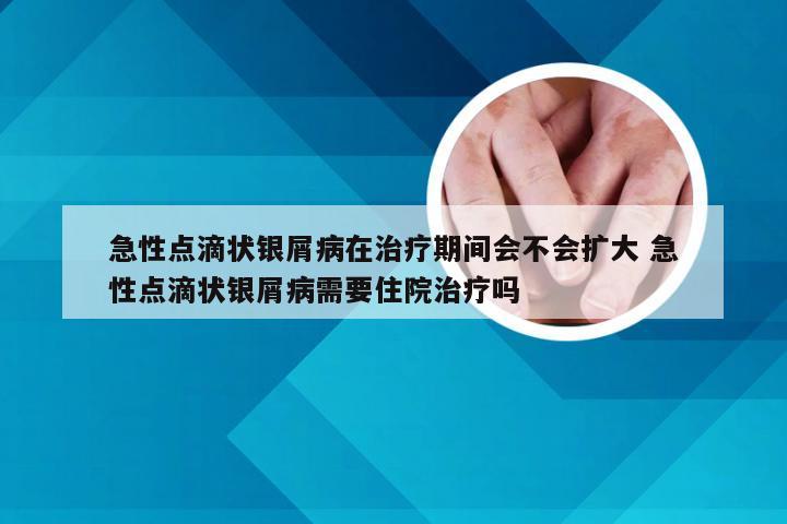 急性点滴状银屑病在治疗期间会不会扩大 急性点滴状银屑病需要住院治疗吗