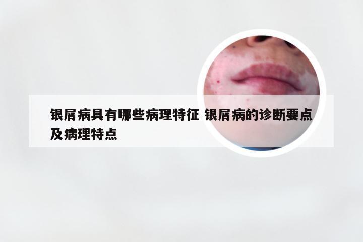 银屑病具有哪些病理特征 银屑病的诊断要点及病理特点