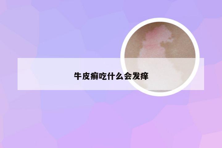 牛皮癣吃什么会发痒