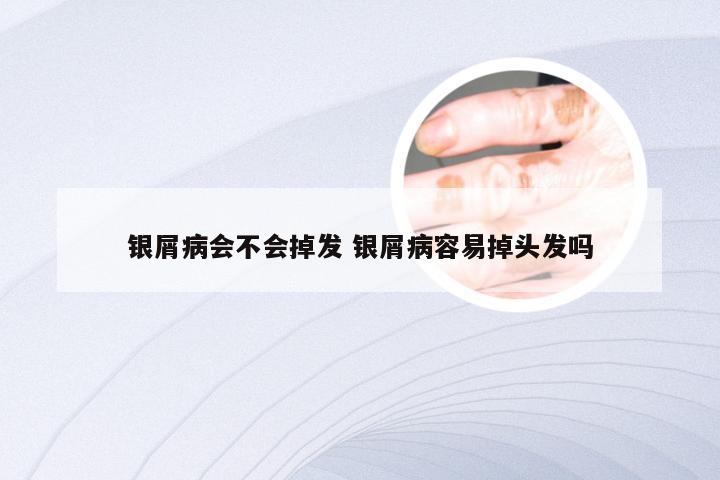 银屑病会不会掉发 银屑病容易掉头发吗