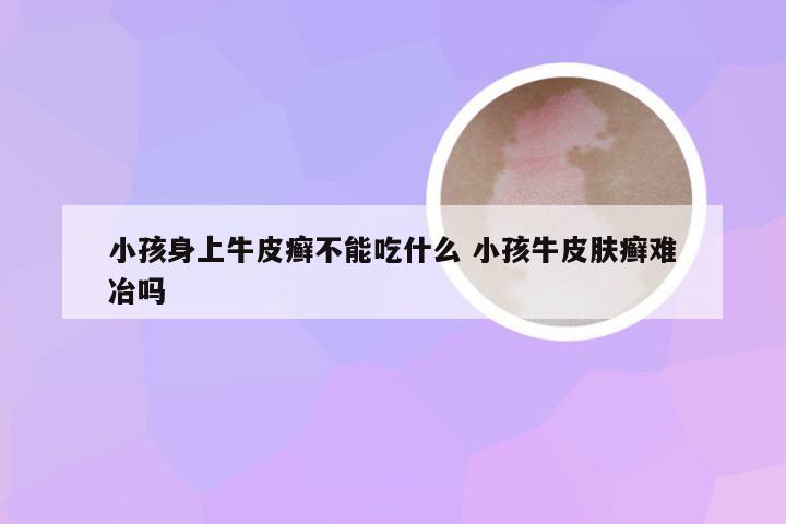 小孩身上牛皮癣不能吃什么 小孩牛皮肤癣难冶吗