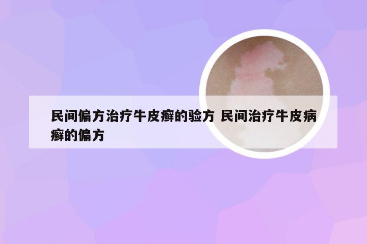 民间偏方治疗牛皮癣的验方 民间治疗牛皮病癣的偏方