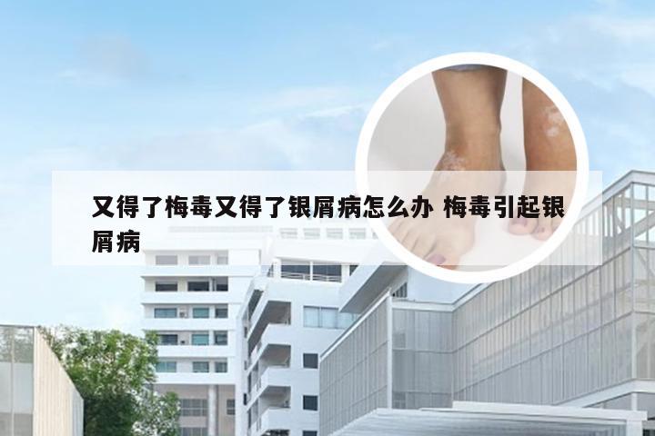 又得了梅毒又得了银屑病怎么办 梅毒引起银屑病