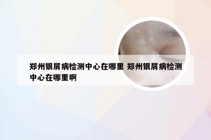 郑州银屑病检测中心在哪里 郑州银屑病检测中心在哪里啊