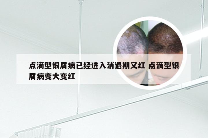 点滴型银屑病已经进入消退期又红 点滴型银屑病变大变红