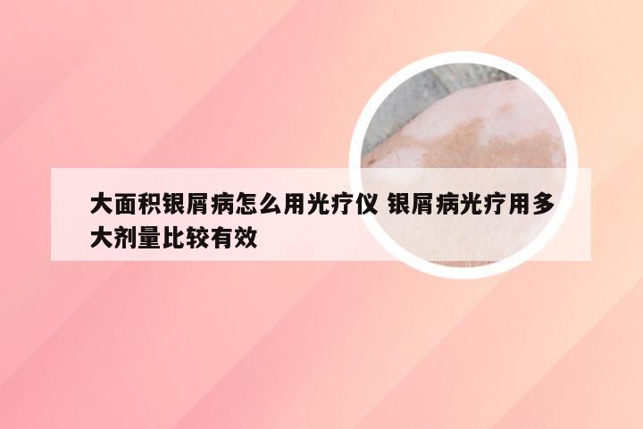 大面积银屑病怎么用光疗仪 银屑病光疗用多大剂量比较有效