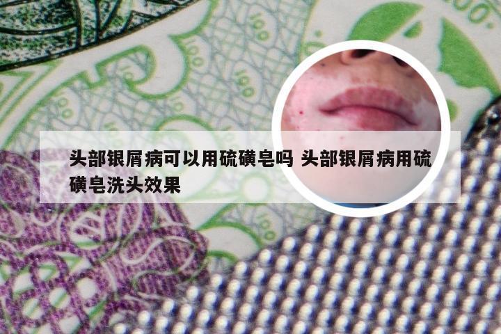 头部银屑病可以用硫磺皂吗 头部银屑病用硫磺皂洗头效果