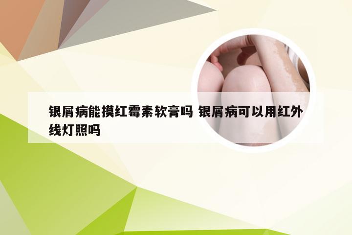 银屑病能摸红霉素软膏吗 银屑病可以用红外线灯照吗