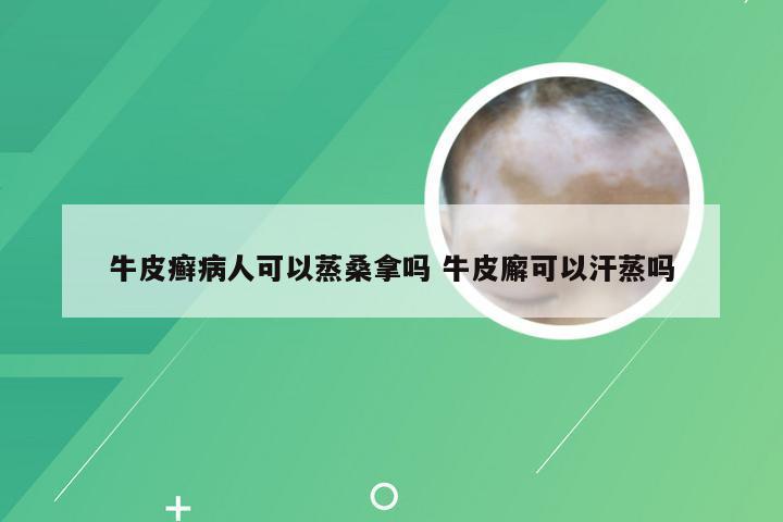 牛皮癣病人可以蒸桑拿吗 牛皮廨可以汗蒸吗