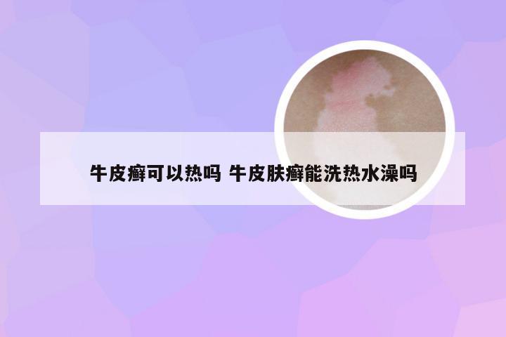 牛皮癣可以热吗 牛皮肤癣能洗热水澡吗