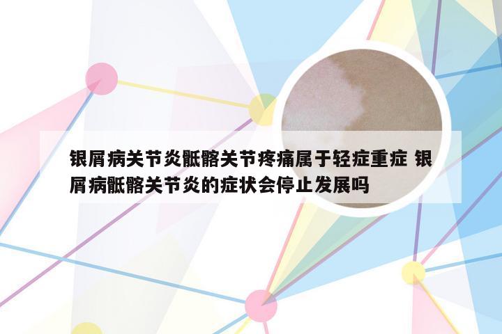 银屑病关节炎骶髂关节疼痛属于轻症重症 银屑病骶髂关节炎的症状会停止发展吗