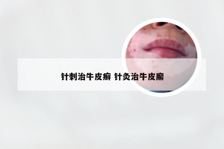 针刺治牛皮癣 针灸治牛皮廨