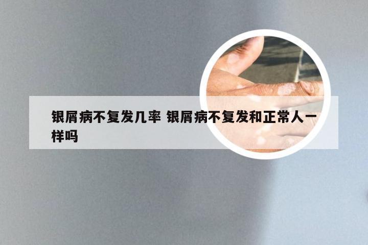 银屑病不复发几率 银屑病不复发和正常人一样吗