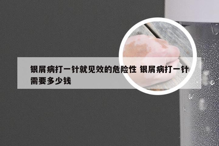 银屑病打一针就见效的危险性 银屑病打一针需要多少钱