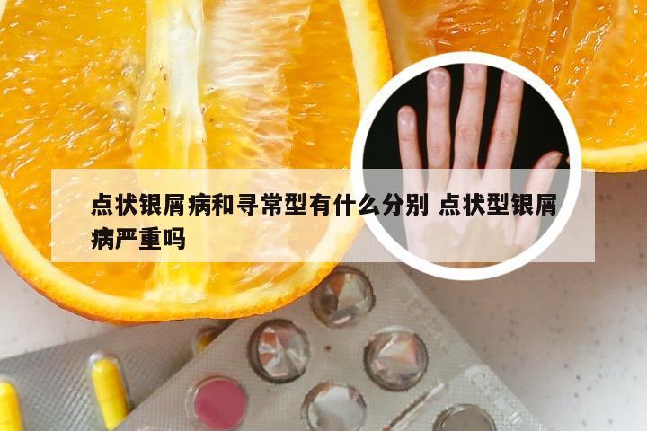 点状银屑病和寻常型有什么分别 点状型银屑病严重吗