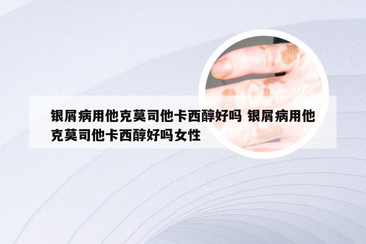 银屑病用他克莫司他卡西醇好吗 银屑病用他克莫司他卡西醇好吗女性