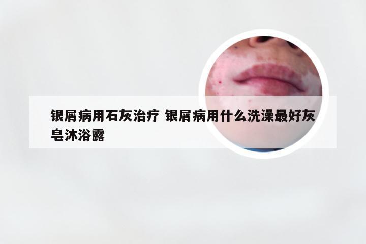 银屑病用石灰治疗 银屑病用什么洗澡最好灰皂沐浴露