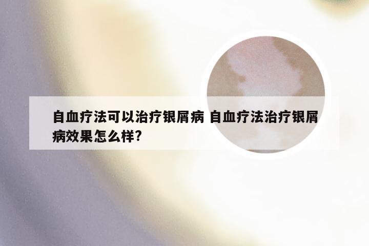 自血疗法可以治疗银屑病 自血疗法治疗银屑病效果怎么样?