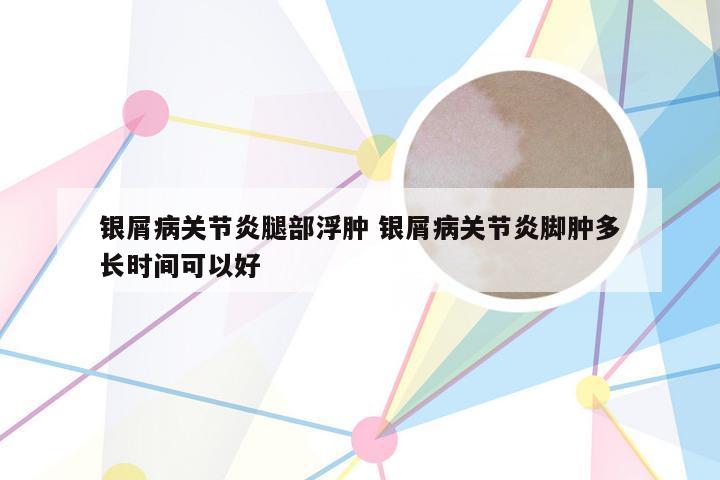 银屑病关节炎腿部浮肿 银屑病关节炎脚肿多长时间可以好