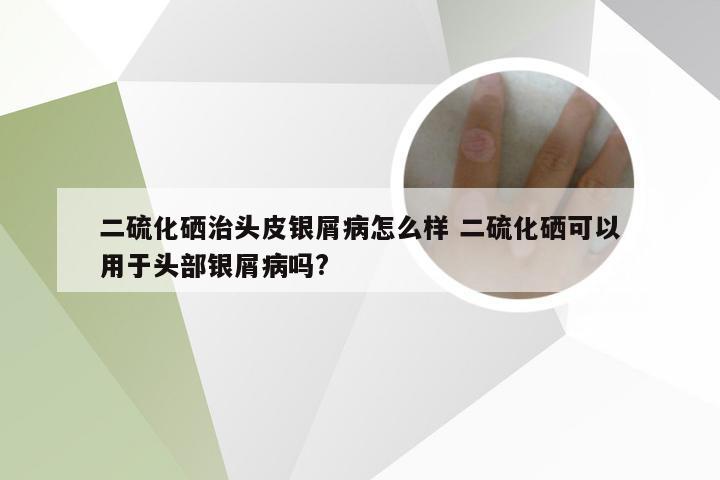 二硫化硒治头皮银屑病怎么样 二硫化硒可以用于头部银屑病吗?