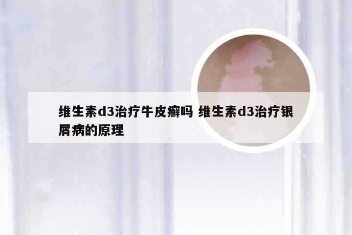 维生素d3治疗牛皮癣吗 维生素d3治疗银屑病的原理