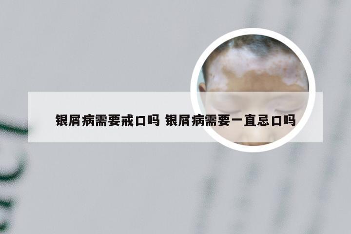 银屑病需要戒口吗 银屑病需要一直忌口吗