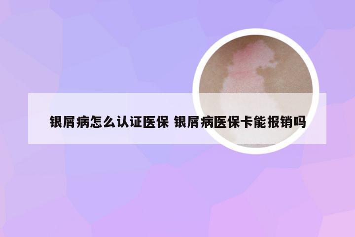 银屑病怎么认证医保 银屑病医保卡能报销吗