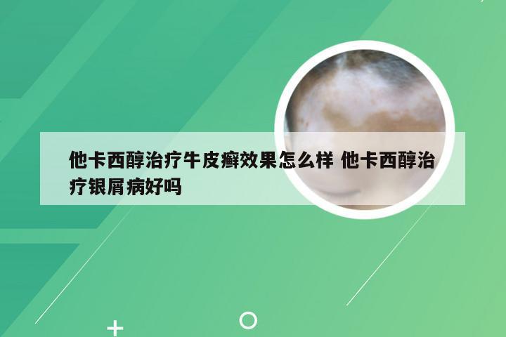 他卡西醇治疗牛皮癣效果怎么样 他卡西醇治疗银屑病好吗