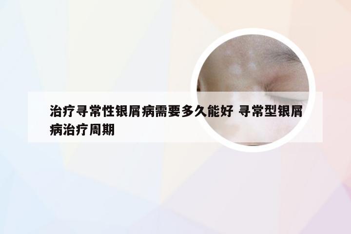 治疗寻常性银屑病需要多久能好 寻常型银屑病治疗周期