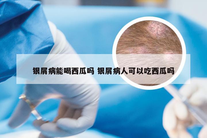 银屑病能喝西瓜吗 银屑病人可以吃西瓜吗