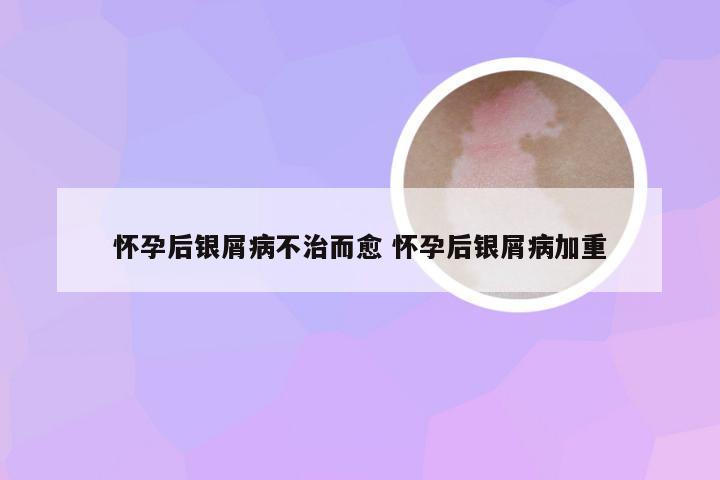 怀孕后银屑病不治而愈 怀孕后银屑病加重