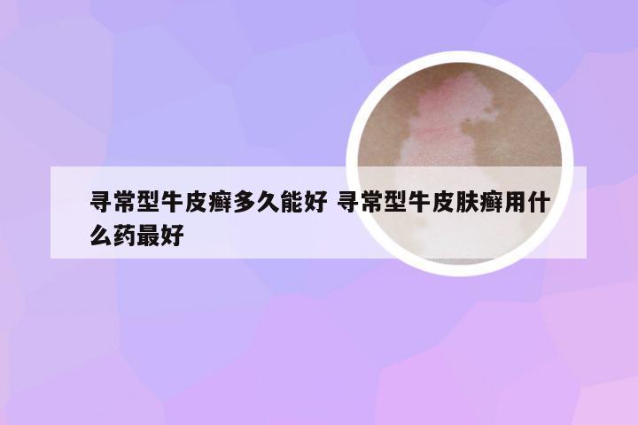 寻常型牛皮癣多久能好 寻常型牛皮肤癣用什么药最好