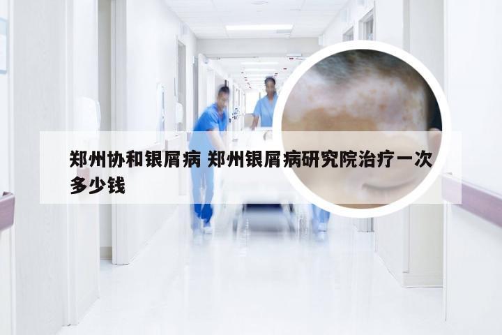 郑州协和银屑病 郑州银屑病研究院治疗一次多少钱