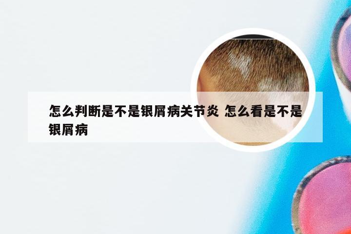 怎么判断是不是银屑病关节炎 怎么看是不是银屑病