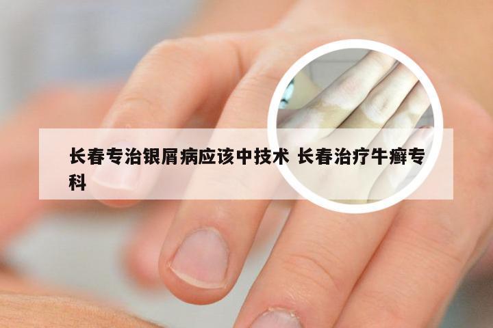 长春专治银屑病应该中技术 长春治疗牛癣专科