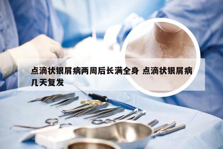 点滴状银屑病两周后长满全身 点滴状银屑病几天复发