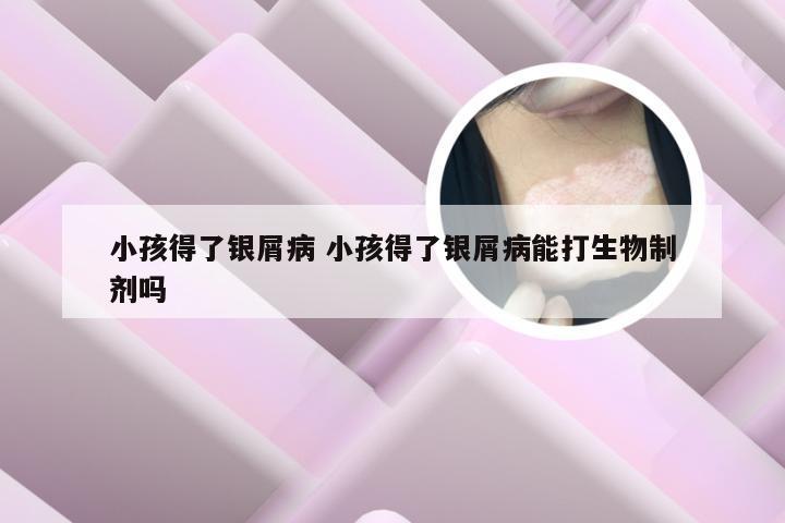 小孩得了银屑病 小孩得了银屑病能打生物制剂吗