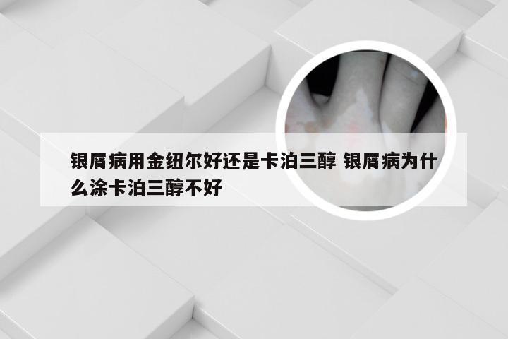 银屑病用金纽尔好还是卡泊三醇 银屑病为什么涂卡泊三醇不好