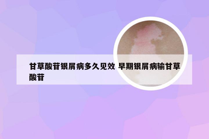 甘草酸苷银屑病多久见效 早期银屑病输甘草酸苷