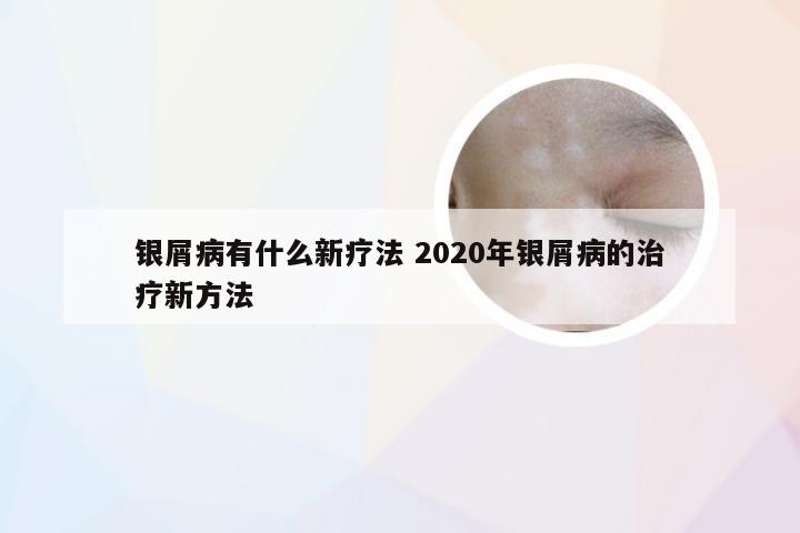 银屑病有什么新疗法 2020年银屑病的治疗新方法