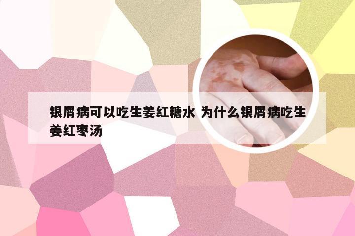 银屑病可以吃生姜红糖水 为什么银屑病吃生姜红枣汤